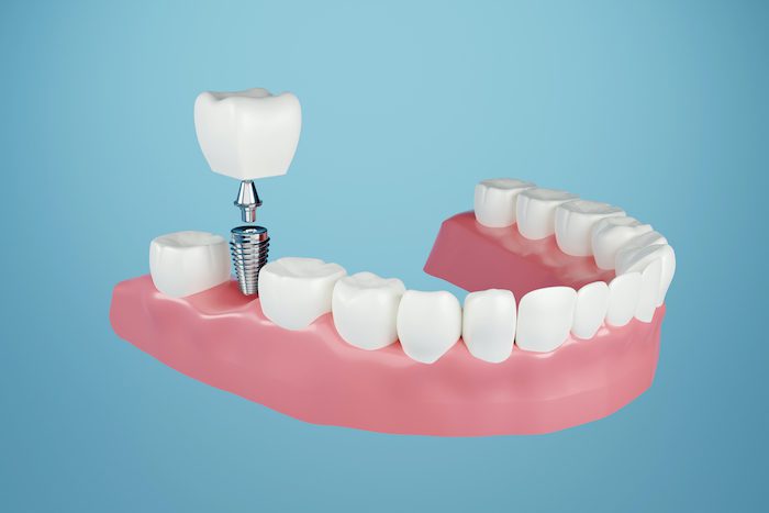 affordable dental implants in denton, texas