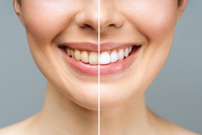 teeth whitening treatment in denton, texas