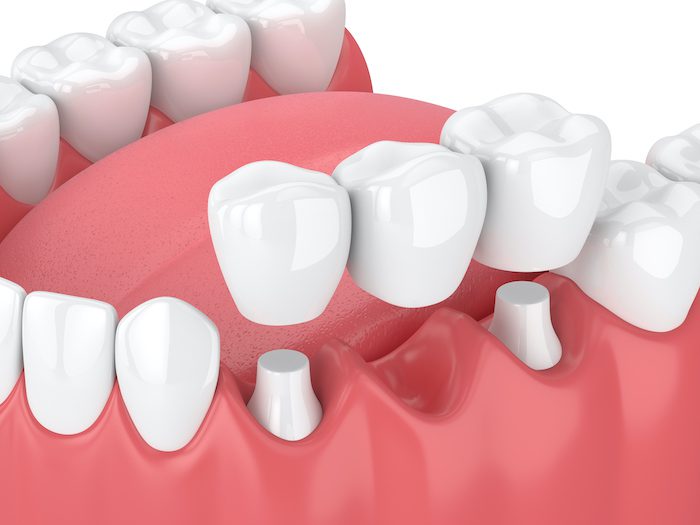 dental bridge treatment in denton, texas