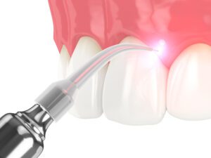 laser dental treatment in denton, texas
