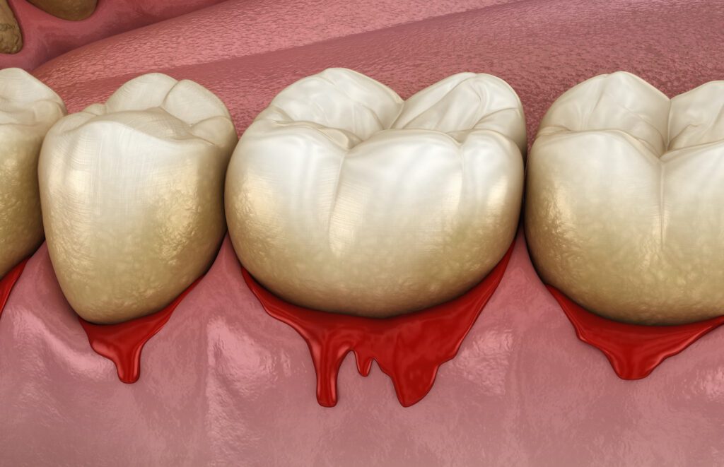 When you have gum disease in Denton, TX, it could affect your teeth as well as the rest of your body.